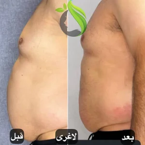 لاغری با دستگاه کول تک