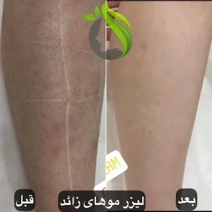 لیزر موهای زائد آقایان