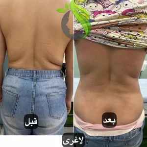 لاغری، فرم دهی و عضله سازی با دستگاه ای ام اسلیم