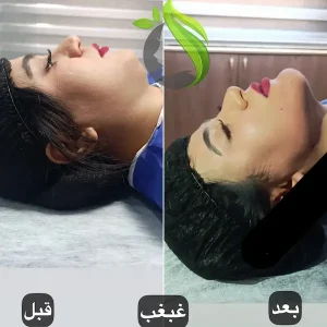 جراحی غبغب