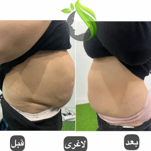 تزریقات لاغری