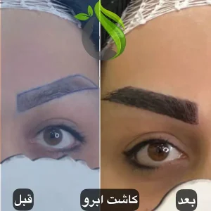 کاشت ابرو