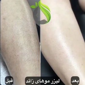لیزر موهای زائد بانوان
