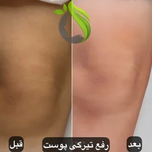 رفع تیرگی پوست