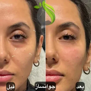 مزوژل جوانسازی پوست
