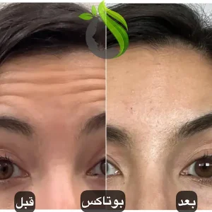 تزریق بوتاکس