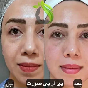 پی‌آرپی (PRP) صورت و پوست