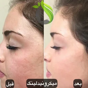 میکرونیدلینگ صورت