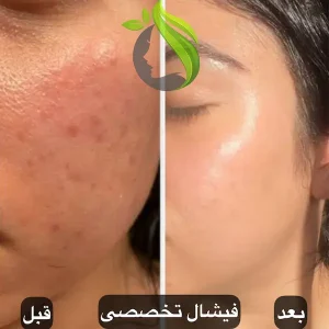 فیشال صورت