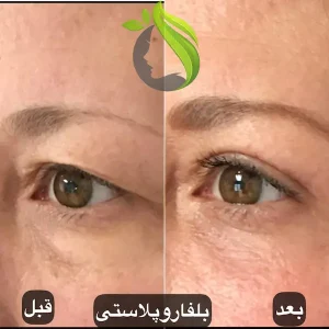 بلفاروپلاستی | جراحی پلک